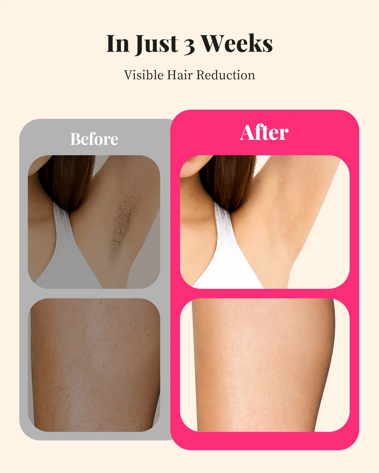 Laser Hair Removal for Women and Men